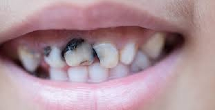 ما هي اسباب تسوس الاسنان الامامية عند الاطفال