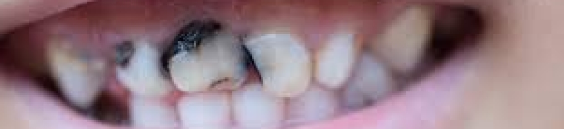 ما هي اسباب تسوس الاسنان الامامية عند الاطفال