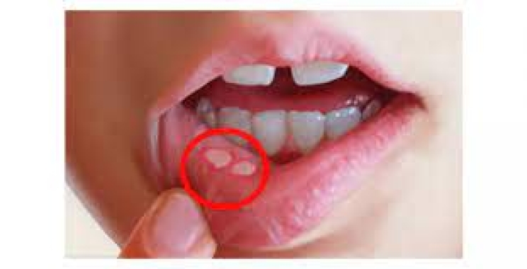 اهم اعراض التهاب الفم من الداخل وطرق علاجها