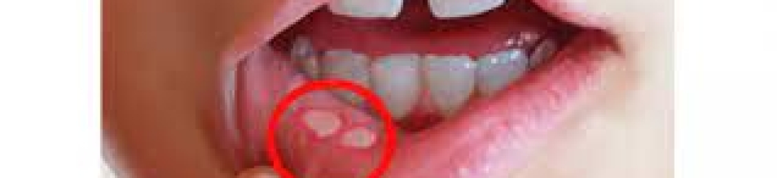 اهم اعراض التهاب الفم من الداخل وطرق علاجها