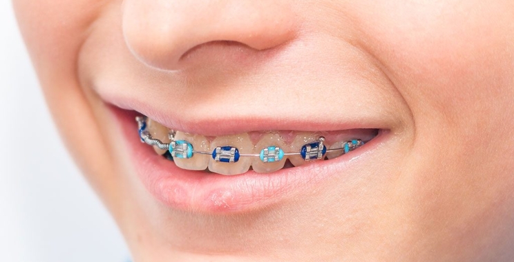 ما هو تقويم اسنان الاطفال وشروطه