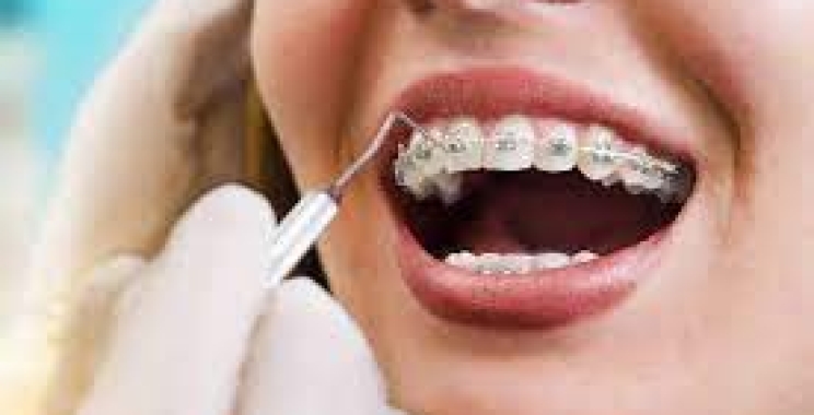 تعرف على مدة تقويم الأسنان للاطفال