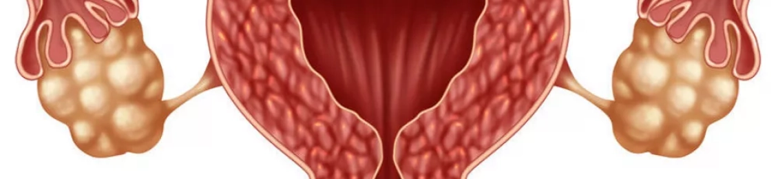 تعرف على اسباب تكيسات المبايض وعلاجها