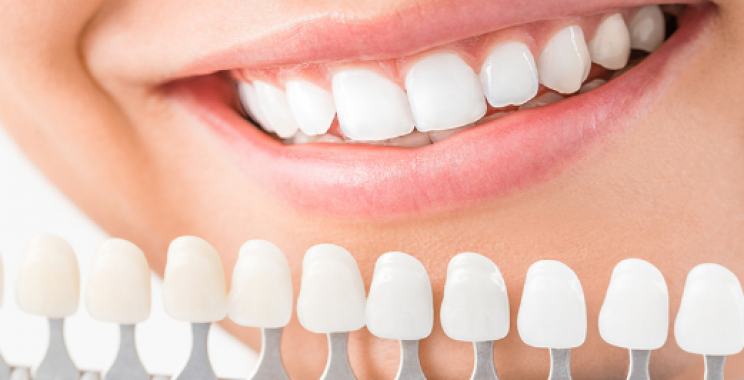 ماهي ابتسامة هوليود وخطوات التركيب والتكلفة المطلوبة من أجل مظهر مثالي للأسنان