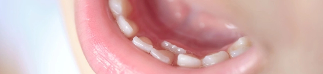 متى تطيح اسنان الاطفال وحمايتها من التسوس