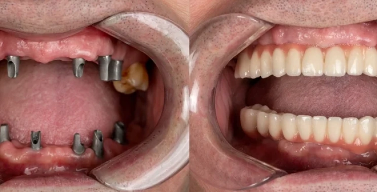 مجمع الطب المتميز: اهم مركز زراعة اسنان في المدينة المنورة 