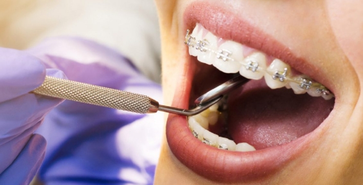 هل تقويم الأسنان مؤلم وما هي اسباب استخدامه؟