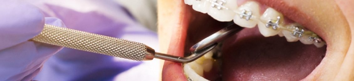 هل تقويم الأسنان مؤلم وما هي اسباب استخدامه؟